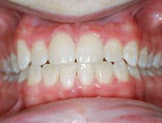 This patient had a narrow upper jaw with crowding and cross-bite of the upper central incisor.  She had treatment to widen the upper arch, correct the cross-bite and uncrowd the teeth.