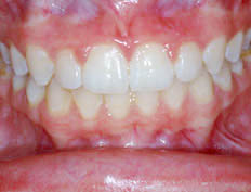 This patient had treatment in the mixed dentition with inadequate space for the upper lateral incisors to erupt, narrow upper jaw, and open-bite in the front of the mouth.  The patients upper jaw was expanded and space was developed for the lateral incisor teeth to erupt.  The open-bite in the upper anterior was closed.