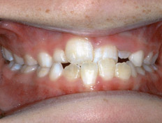 This patient had a narrow upper jaw with crowding and cross-bite of the upper central incisor.  She had treatment to widen the upper arch, correct the cross-bite and uncrowd the teeth.