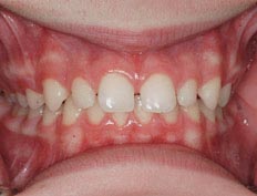 This patient had spacing and alignment problems with the upper teeth and a deep overbite. The overbite was corrected, teeth aligned and spaces closed.