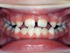 This patient had treatment in the mixed dentition with inadequate space for the upper lateral incisors to erupt, narrow upper jaw, and open-bite in the front of the mouth.  The patients upper jaw was expanded and space was developed for the lateral incisor teeth to erupt.  The open-bite in the upper anterior was closed.